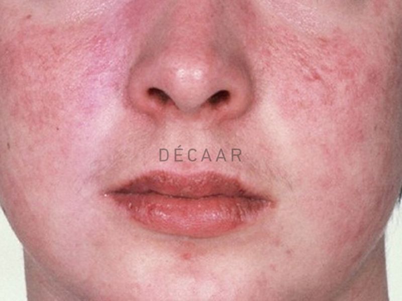 peel da có được ăn trứng không